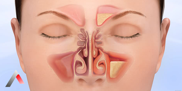 What_Is_Sinusitis_b5447455.webp