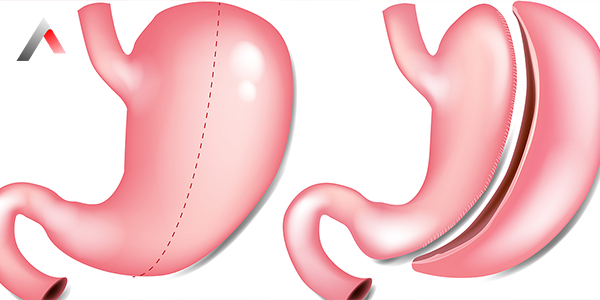 What_Is_Stomach_Surgery__Gastrectomy__8a3175c7.webp