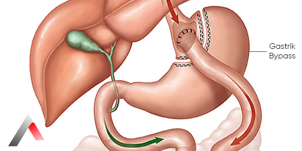 What_is_Gastric_Bypass_721bc2ff.webp