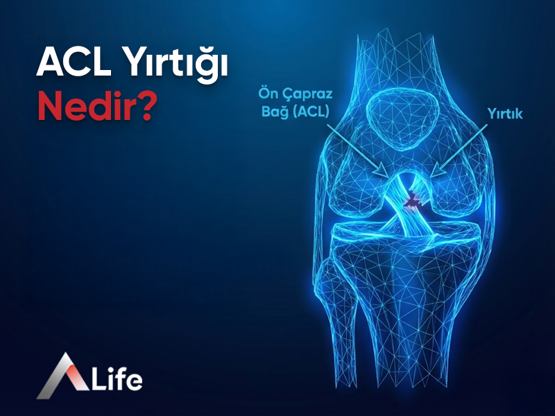 ACL Yırtığı Nedir?