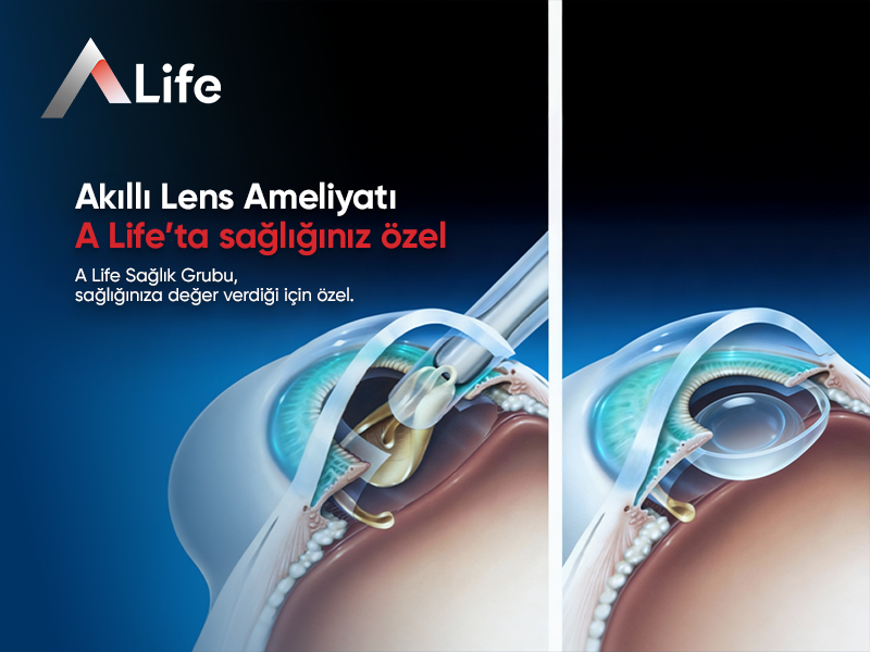 Akıllı Lens (Göz İçi Lens) Ameliyatı