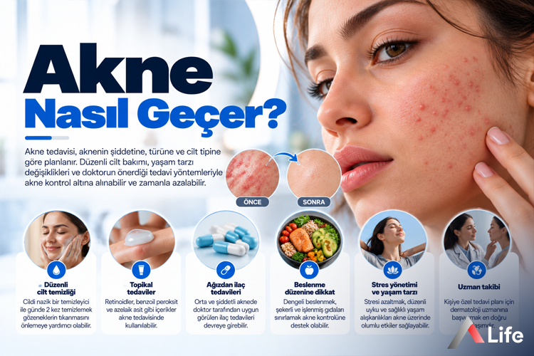 akne-nasil-gecer_29ab8e28.webp