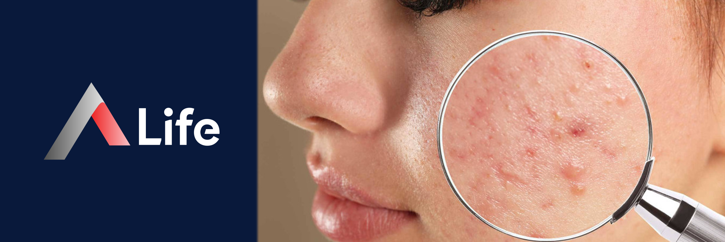 akne_nas__l_ge__er_49c59ce8.webp