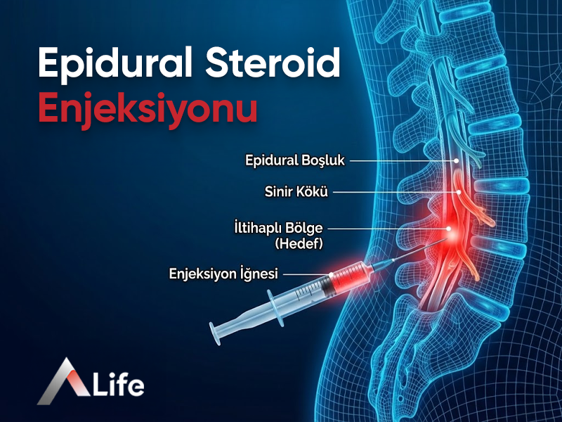 Epidural Steroid Enjeksiyonu