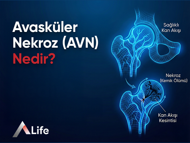 Avasküler Nekroz (AVN) Nedir?