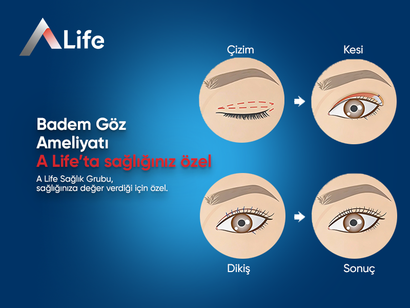 Badem Göz Ameliyatı