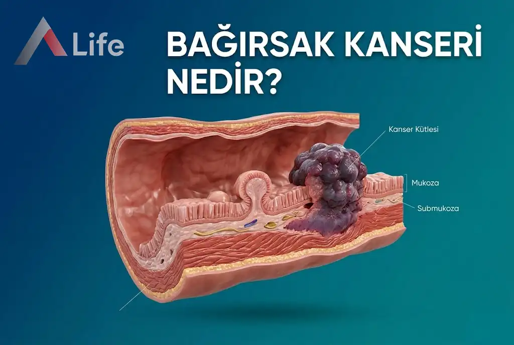Bağırsak Kanseri Nedir ?