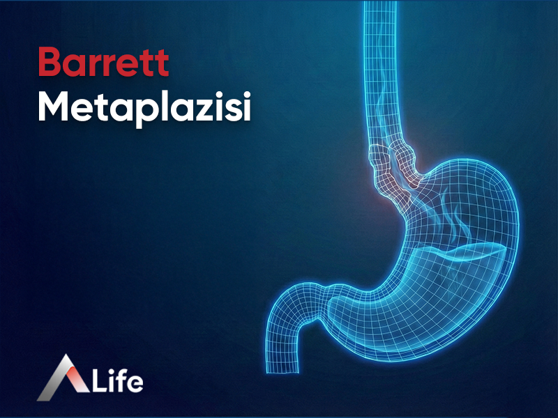 Barrett Metaplazisi