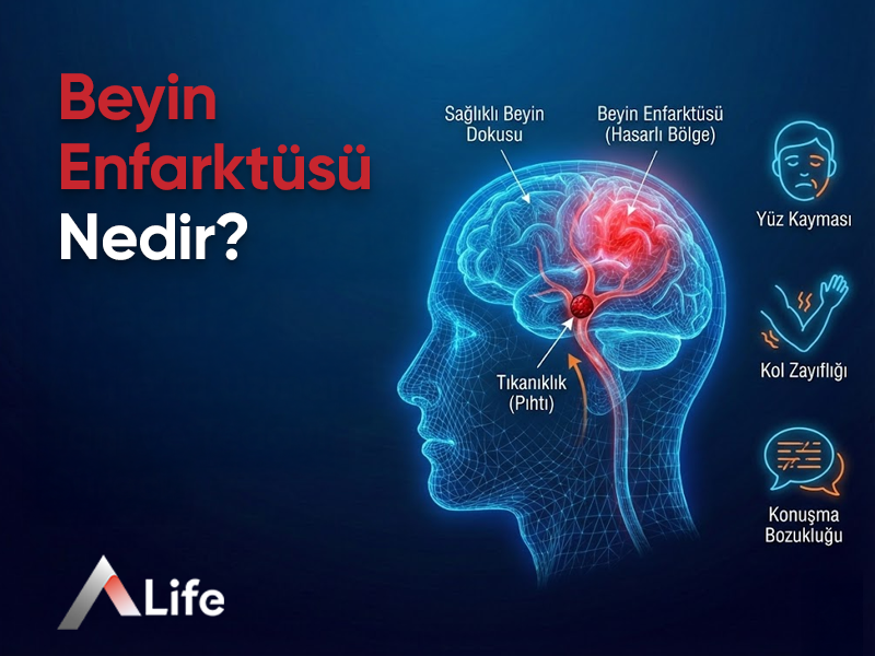 Beyin Enfarktüsü Nedir ?