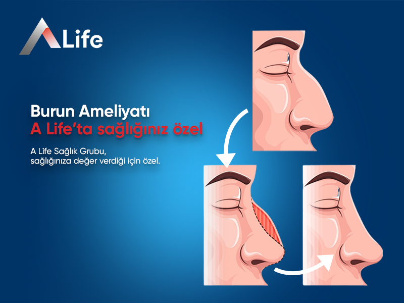 Burun Ameliyatı
