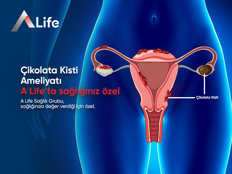 Çikolata Kisti Ameliyatı