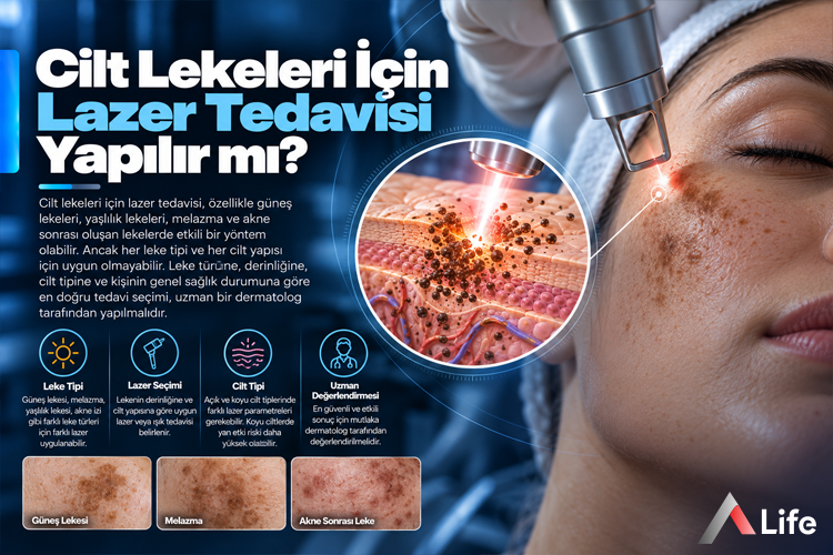 cilt-lekeleri-icin-lazer-tedavisi-yapilir-mi_a9e7b13b.webp