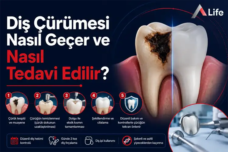 dis-curumesi-nasil-gecer-ve-nasil-tedavi-edilir_06092057.webp