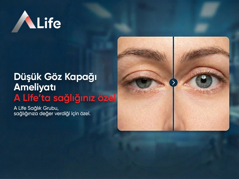 Düşük Göz Kapağı Ameliyatı (Ptosis)