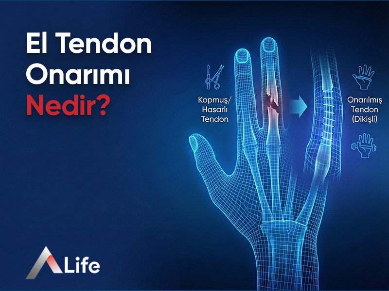 El Tendon Onarımı Nedir ?