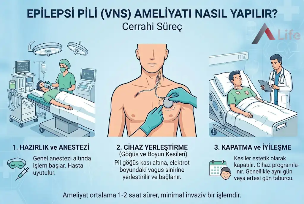 epilepsi-pili-vagal-sinir-stim__lasyonu-nedir-ameliyati-nasil-yapilir-life-ankara_652ac94e.webp