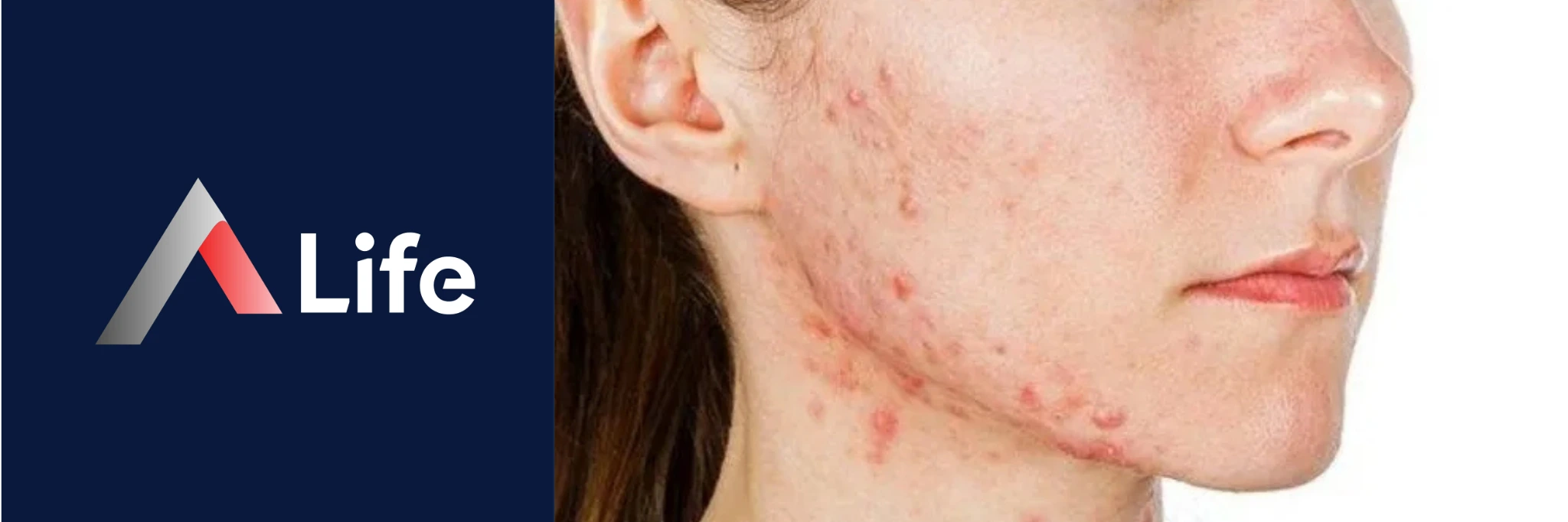 ergenlikte_akne_g__rseli_9e1dc650.webp