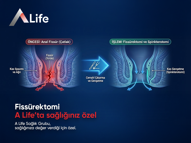 Fissürektomi Nedir?