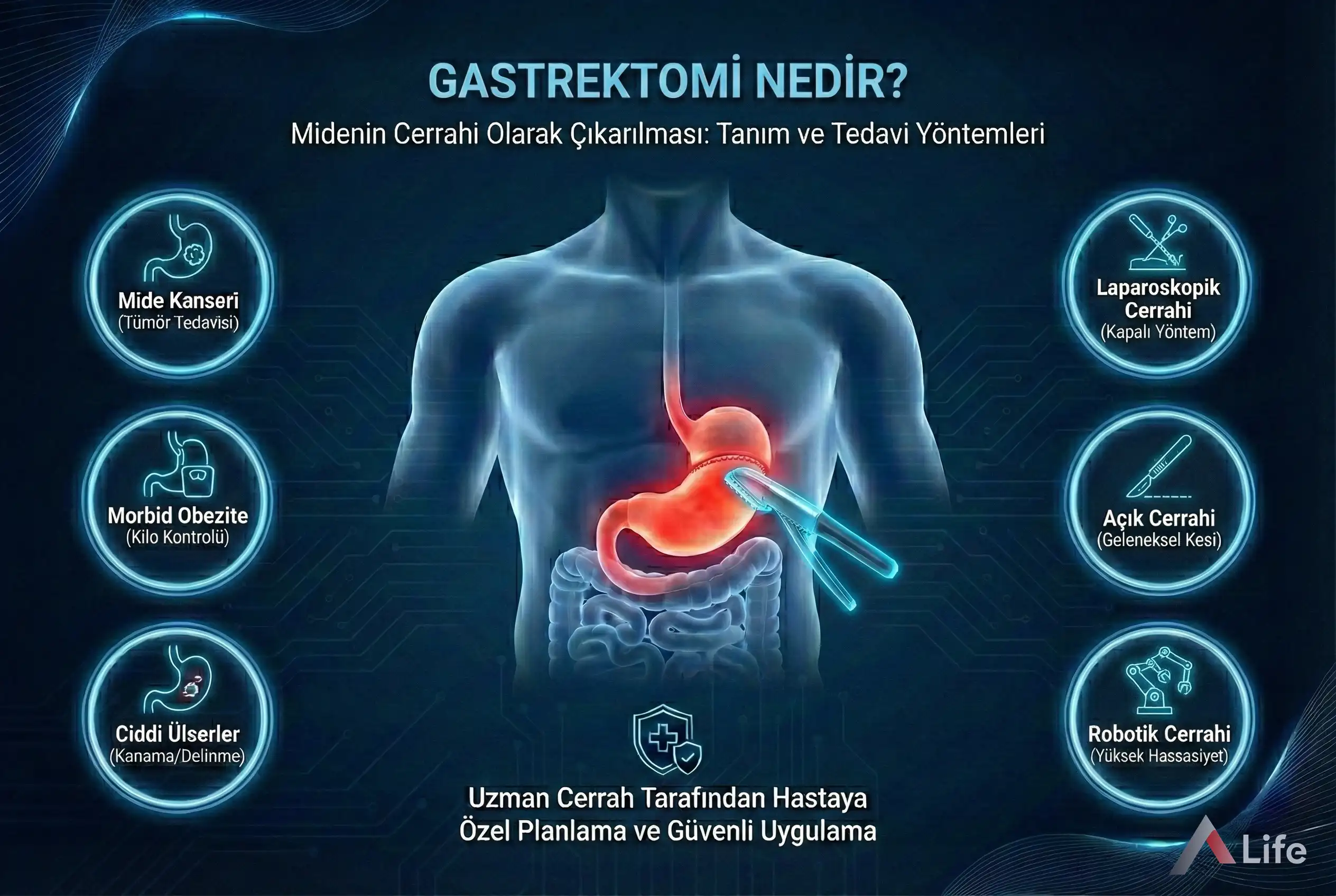gastrektomi-nedir-mide-ameliyati-mide-rezeksiyonu-a-life-ankara_ace69bb9.webp