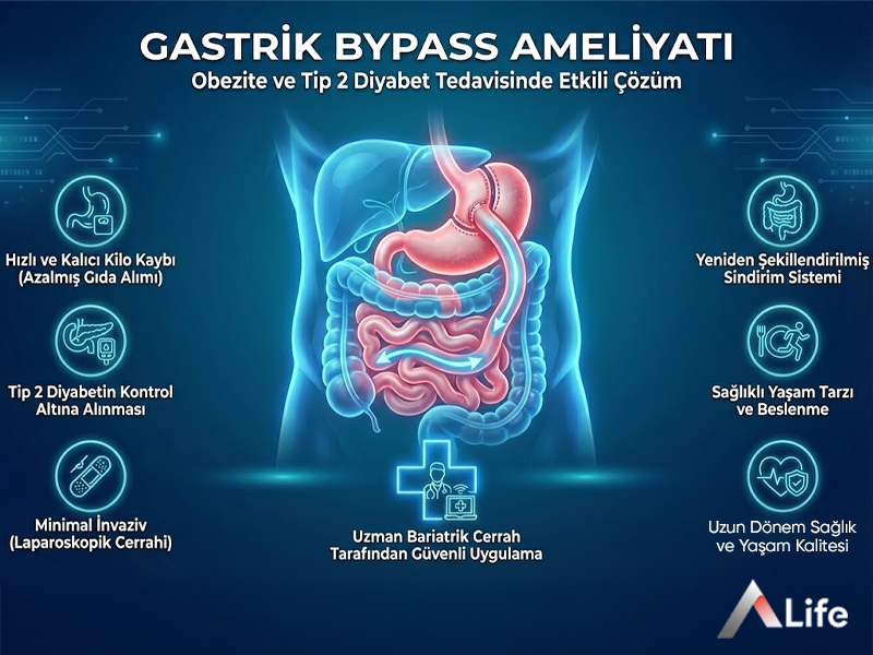 Gastrik Bypass