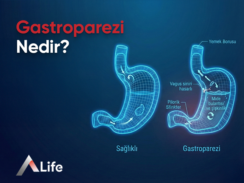 Gastroparezi Nedir?