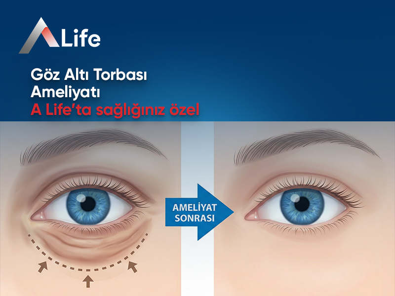 Göz Altı Torbası Ameliyatı Nedir?