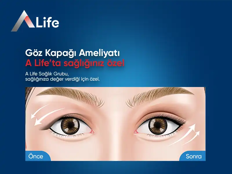 Göz Kapağı Ameliyatı | Estetik Cerrahisi