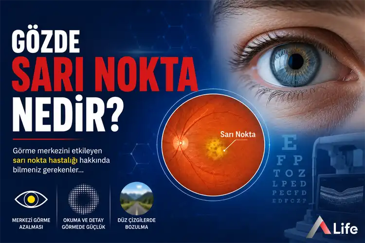 gozde-sari-nokta-nedir_0d5e4eab.webp