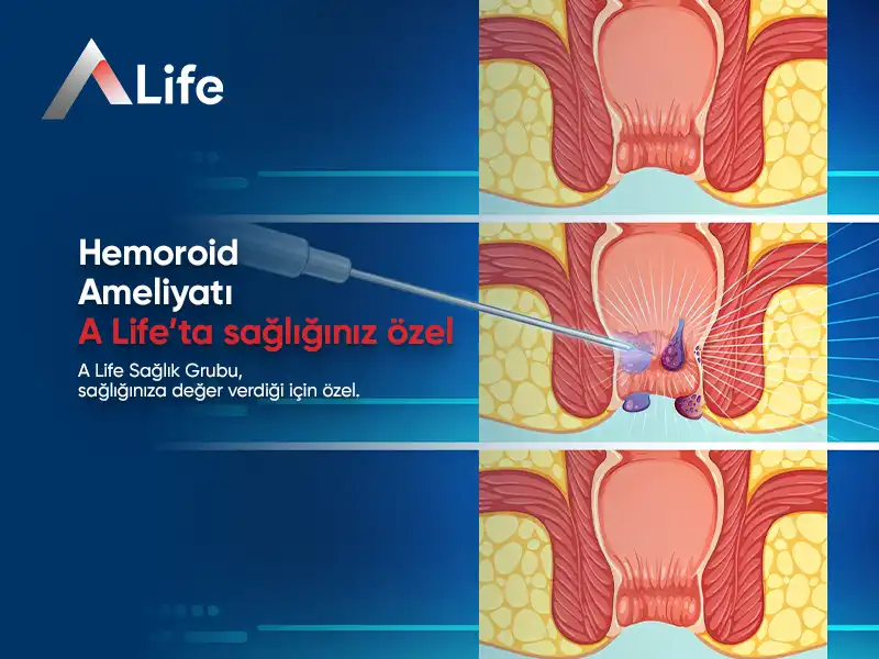 Hemoroid Ameliyatı