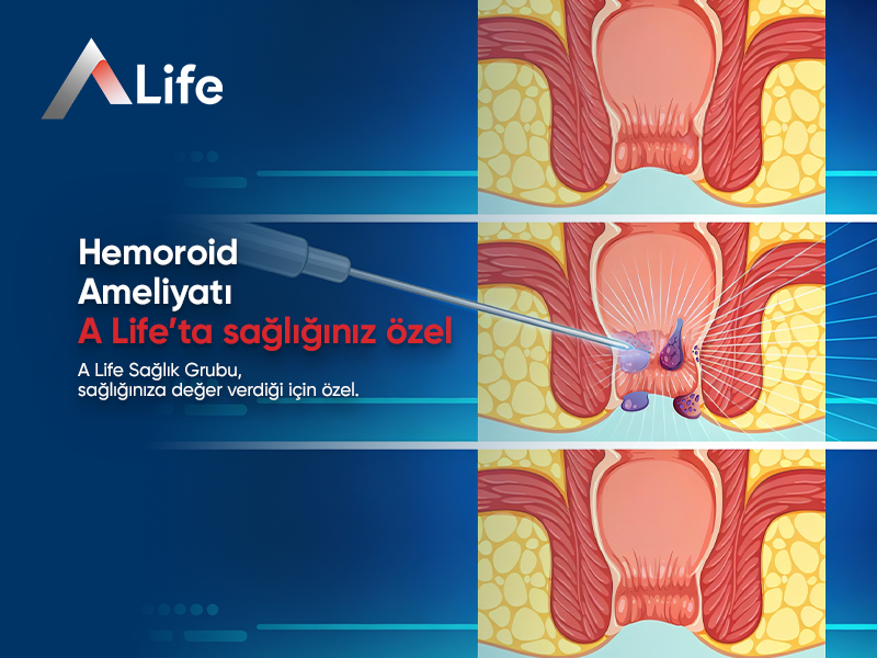 Hemoroid Ameliyatı