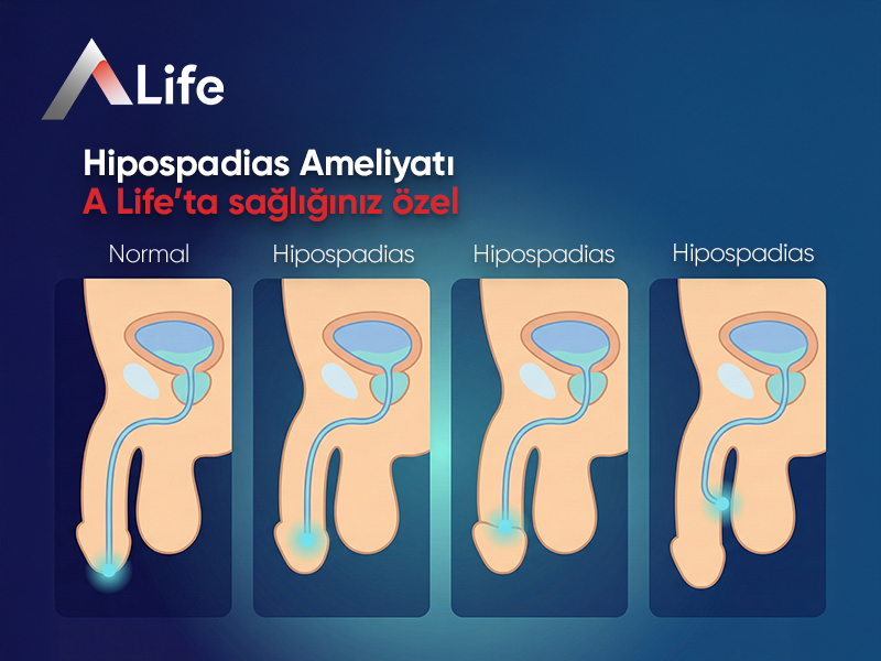 Hipospadias Ameliyatı