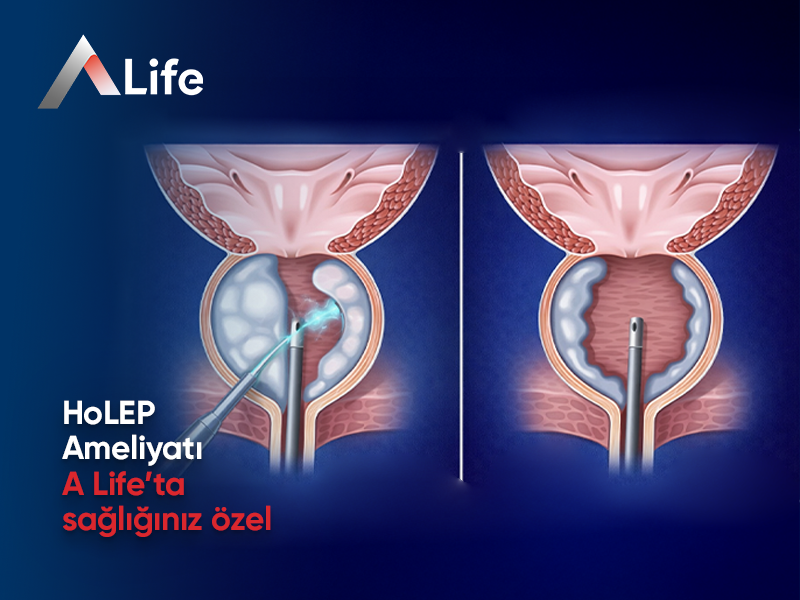 HoLEP Ameliyatı