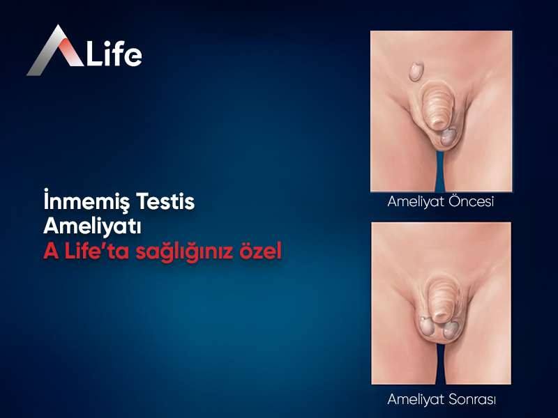 İnmemiş Testis Ameliyatı