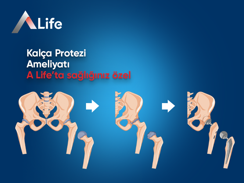 Kalça Protezi Ameliyatı