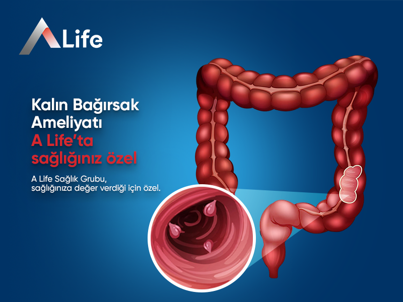 Kalın Bağırsak Ameliyatı