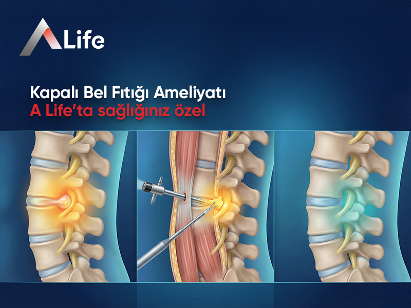 Kapalı Bel Fıtığı Ameliyatı