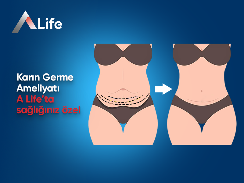 Karın Germe Ameliyatı