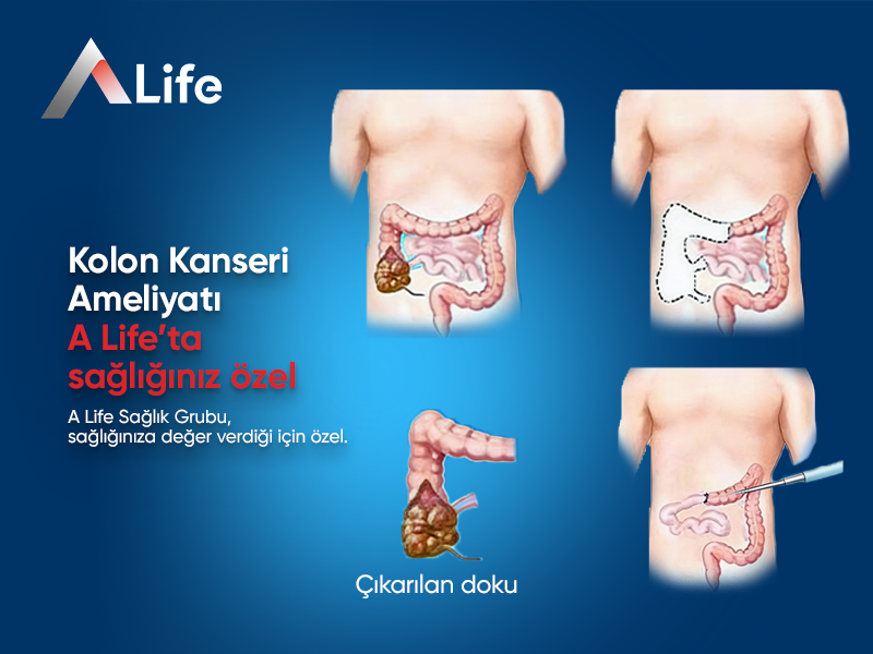 Kolon Kanseri Ameliyatı