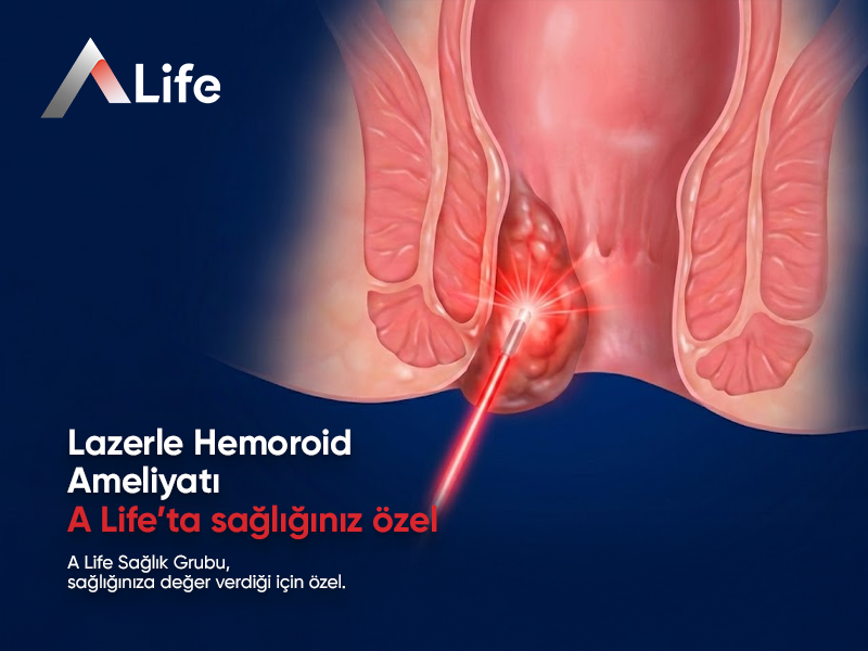 Lazerle Hemoroid Ameliyatı