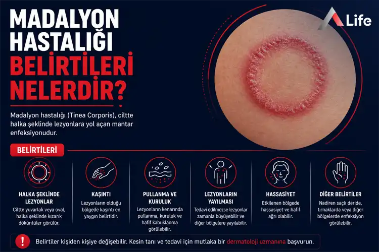 madalyon-hastaligi-belirtileri-nelerdir_e3d57f91.webp