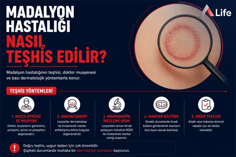madalyon-hastaligi-nasil-teshis-edilir_2ae6f85b.webp