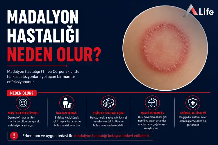 madalyon-hastaligi-neden-olur_89d0791c.webp