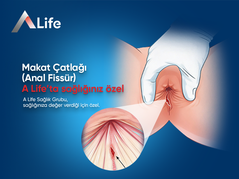Makat Çatlağı (Anal Fissür)