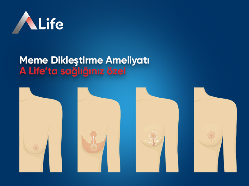 Meme Dikleştirme Ameliyatı