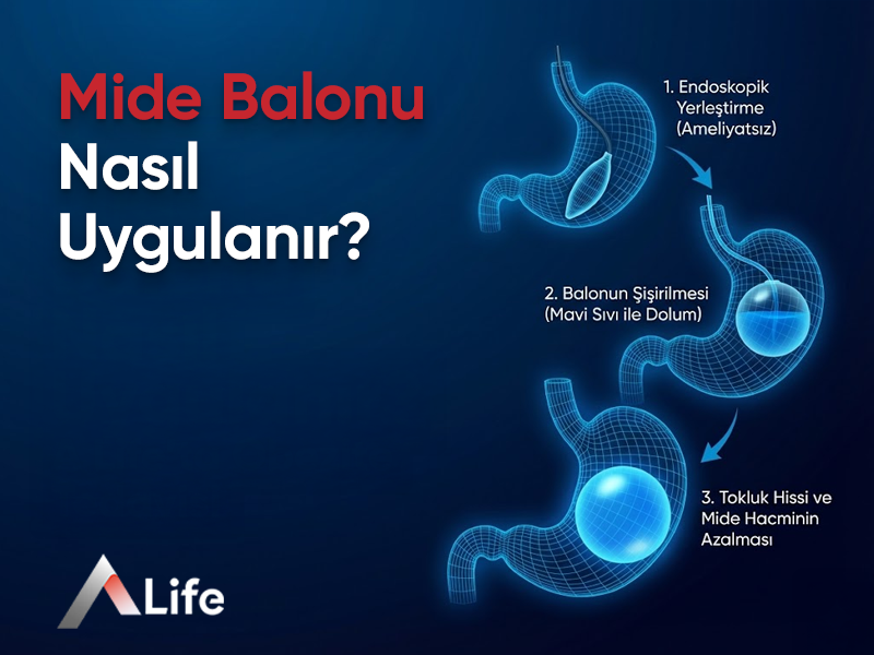 Mide Balonu Nasıl Uygulanır?