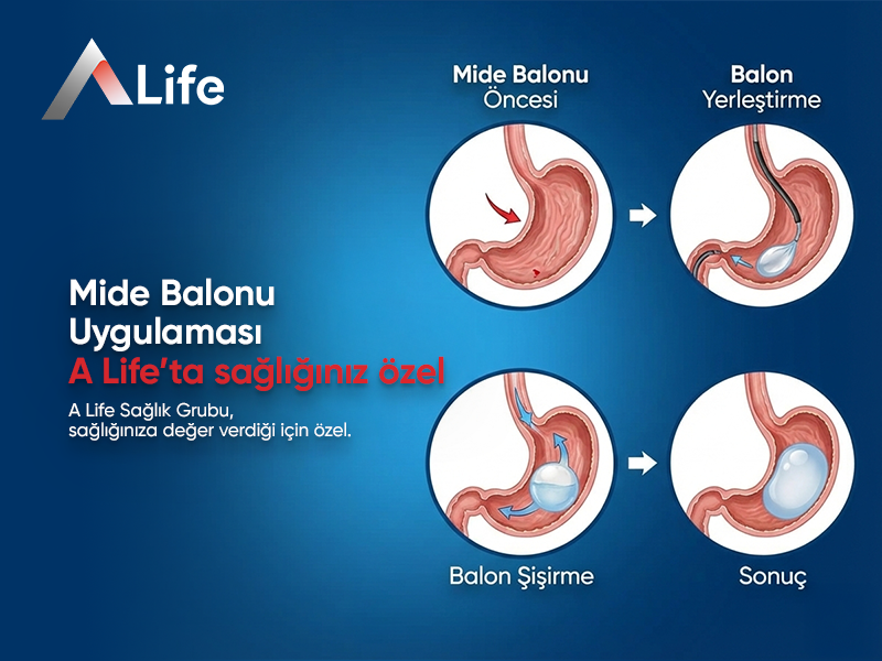 Mide Balonu Uygulaması