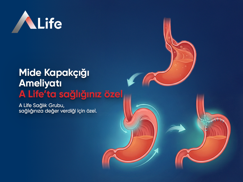 Mide Kapakçığı Ameliyatı