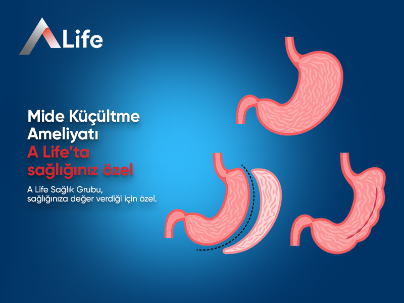 Mide Küçültme Ameliyatı