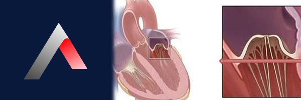 mitral_kapak_prolapsusu_d6a41622.webp