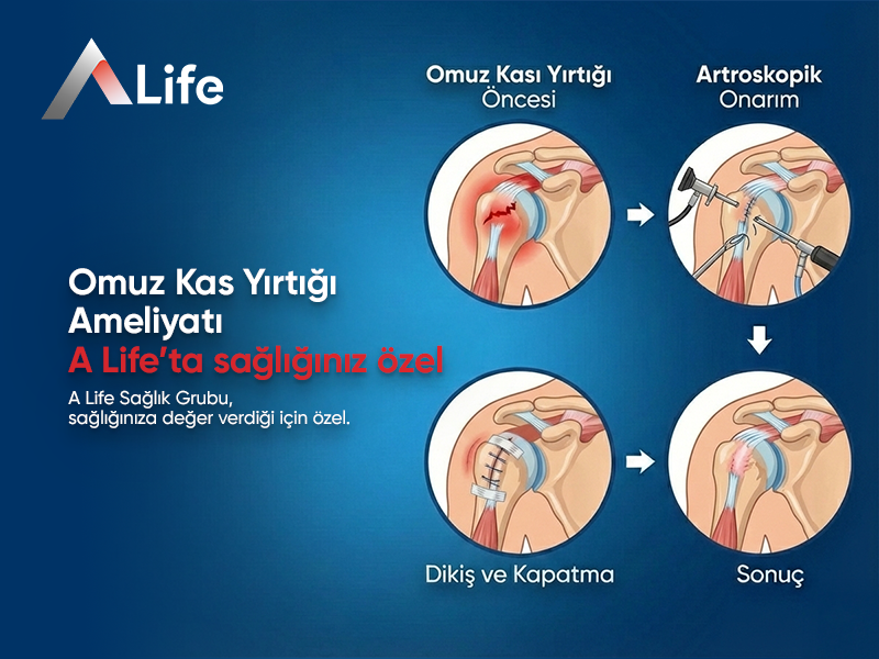 Omuz Kas Yırtığı Ameliyatı